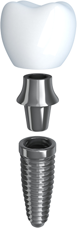 Dental Implant illustration showing the different parts of the implant