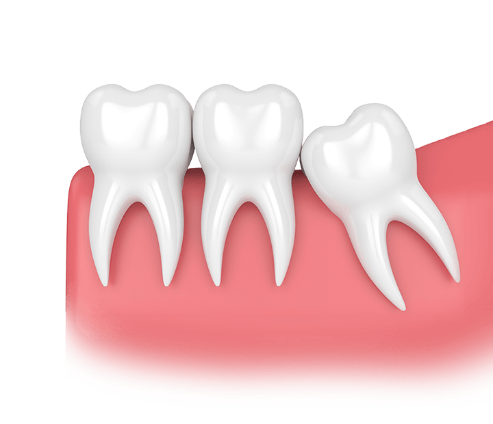 wisdom teeth illustration showing an impacted tooth